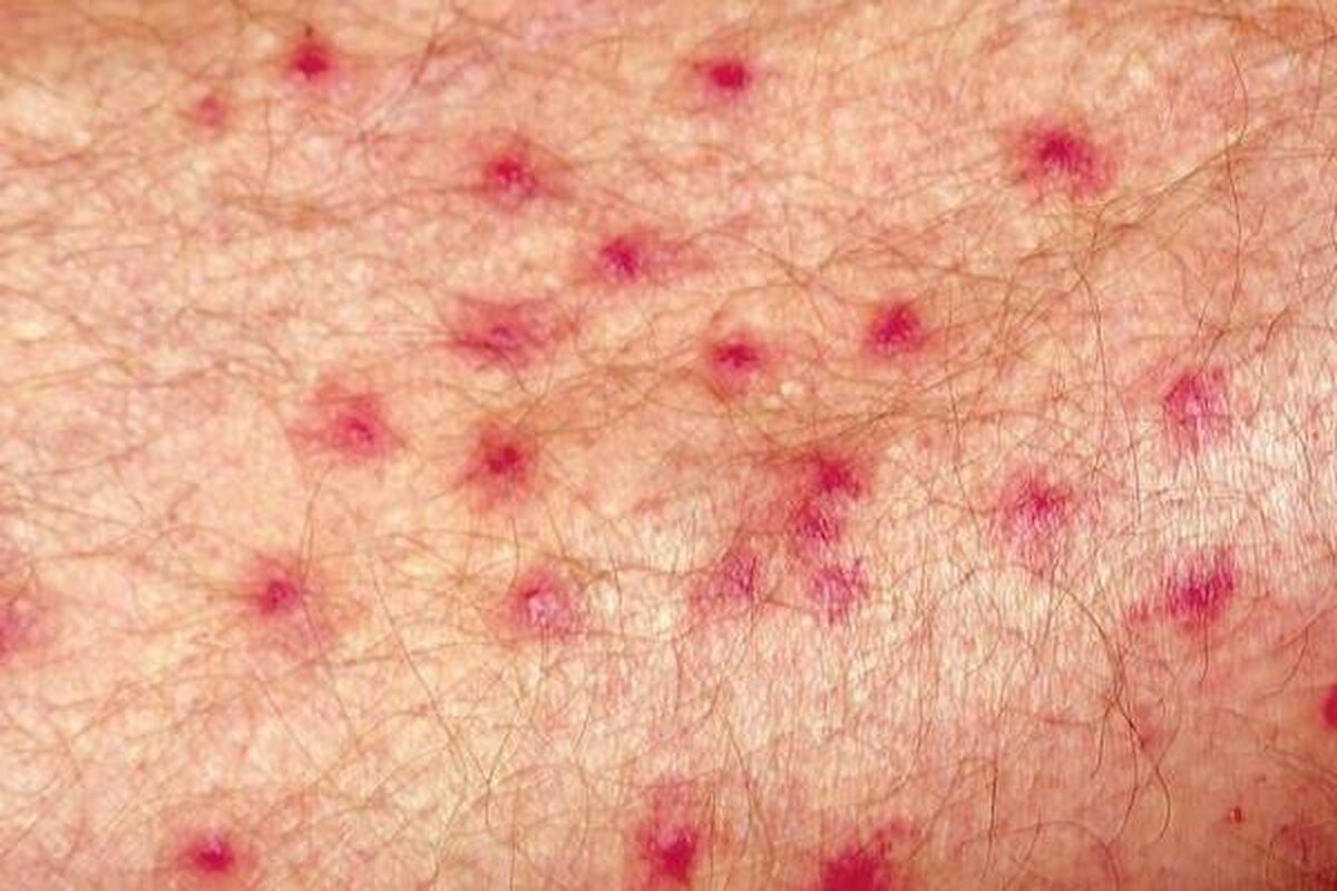 بیش از ۱۵ علت دانه های قرمز بدون خارش روی پوست | درمان پوست با این روش های کاربردی