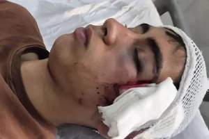 تعلیق معلم و ورود دادستان بم به پرونده مصدومیت دانش‌آموز دهبکری
