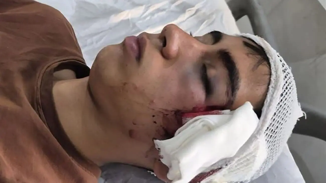 تعلیق معلم و ورود دادستان بم به پرونده مصدومیت دانش آموز دهبکری