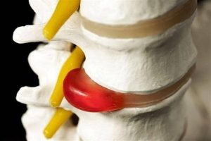 دبیر انجمن درد: تشخیص دیسک کمر به‌معنای نیاز به جراحی نیست